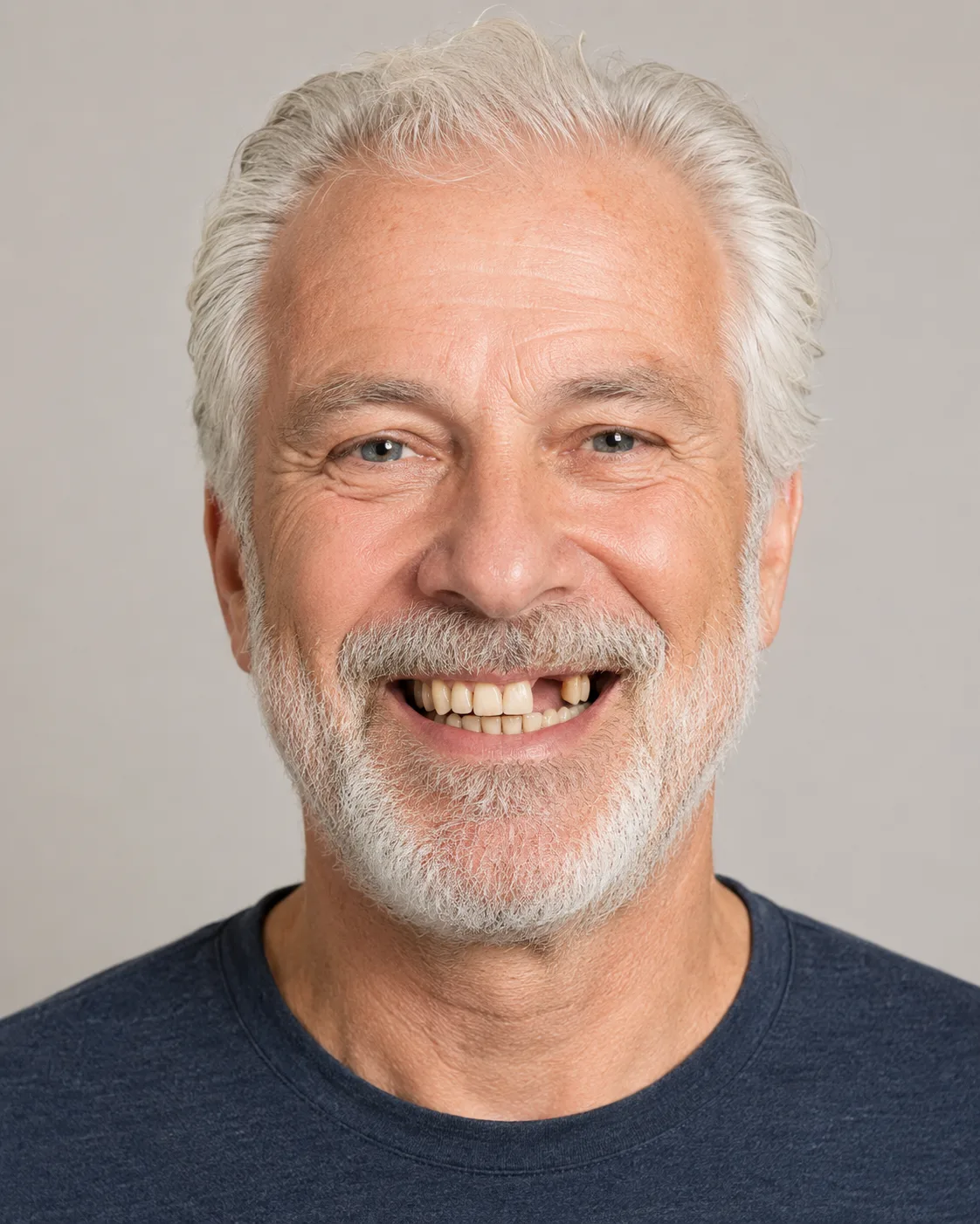 Patient's smile before dental implant treatment