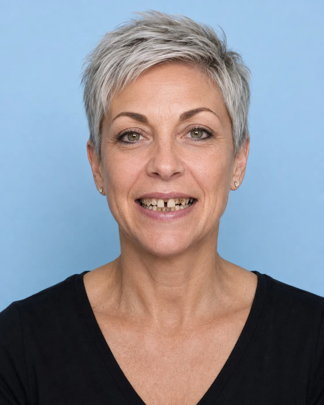 Patient smile before full mouth restoration simulation