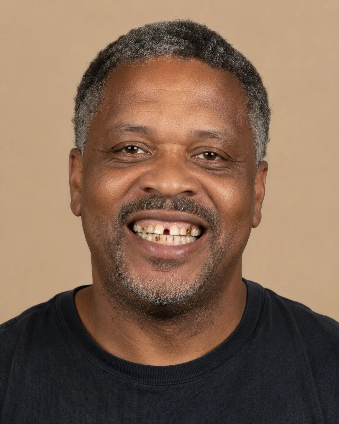Patient smile before full mouth restoration simulation